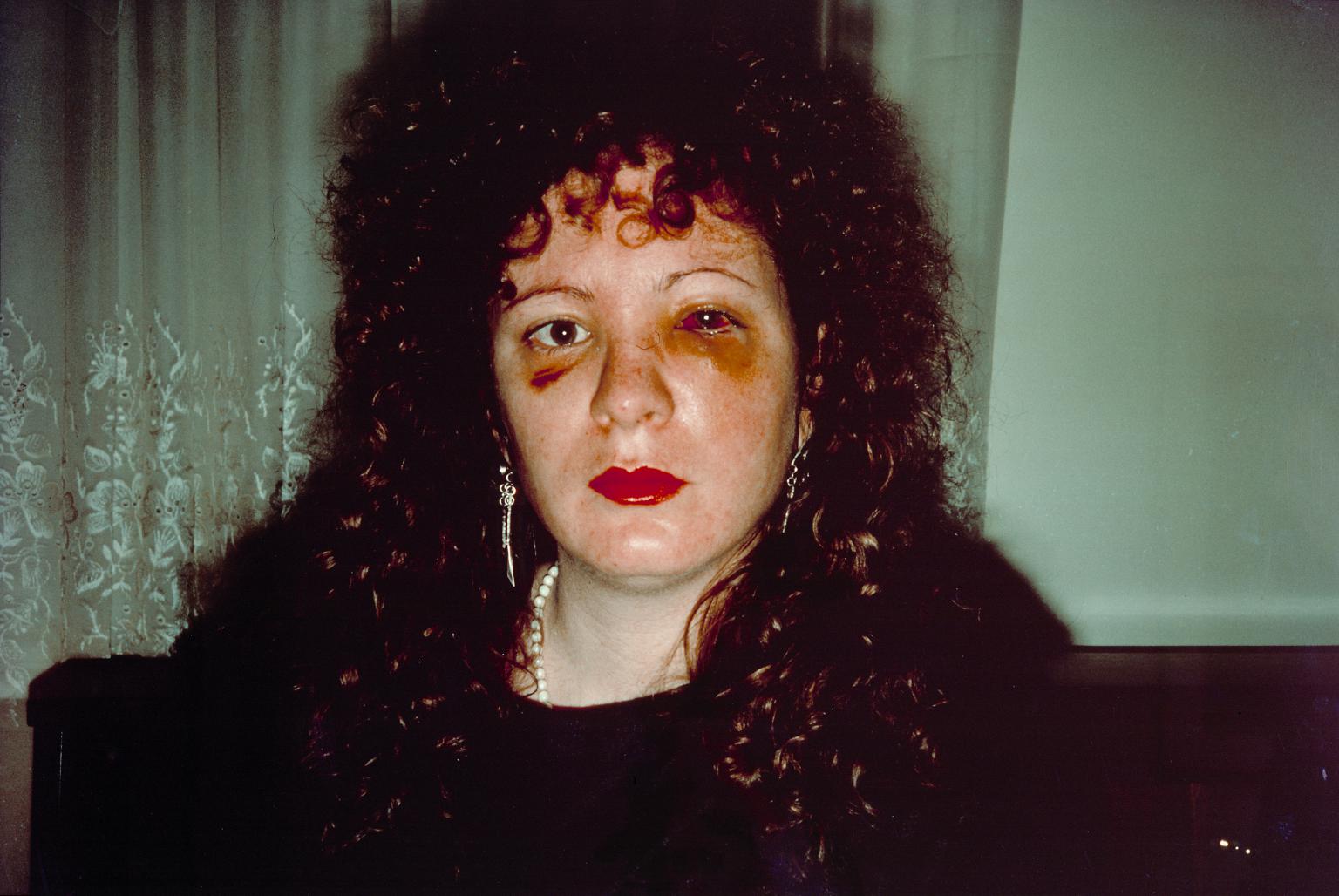 Nan One Month After Being Battered, 1984.